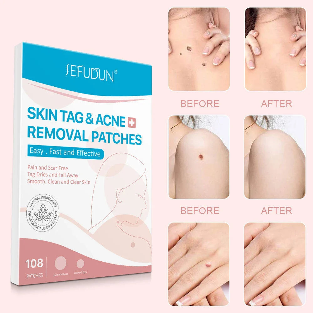 Professional Skin Tag Remover Patches - Discreet, Effective, and Scar-Free Skin Tag Removal Solution