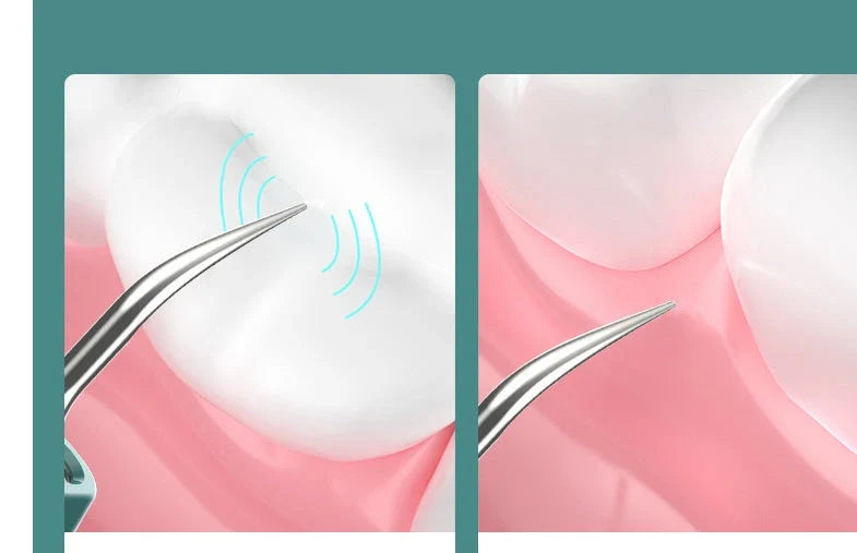Close-up view of the high-powered dental cleaning tool with visual assistance and stainless steel construction
