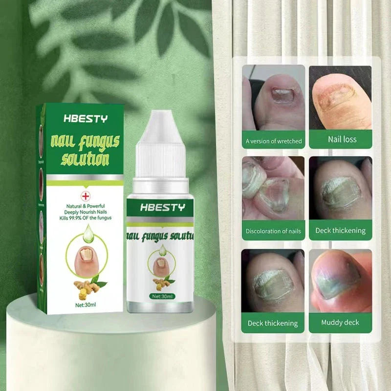Nail Fungus Treatment Solution with Natural Ingredients Like Honeysuckle and Hyaluronic Acid