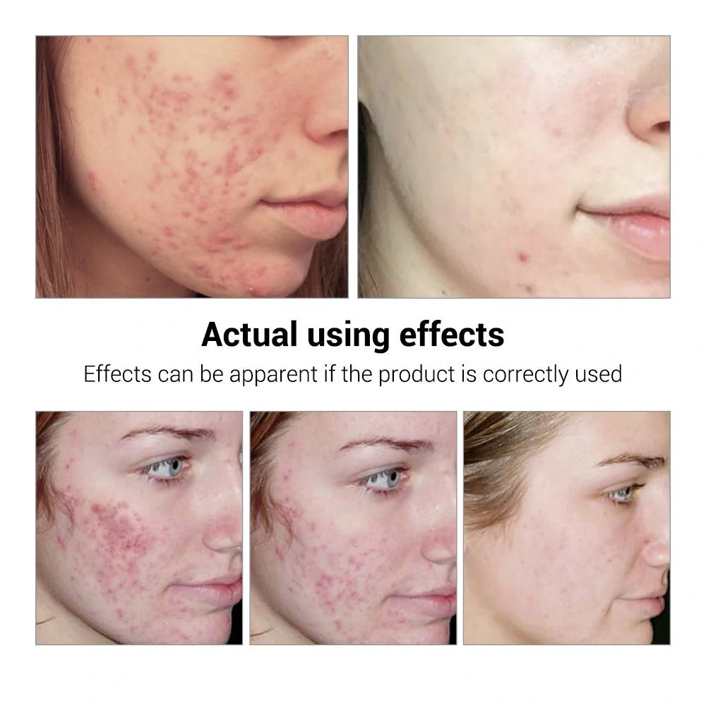 BREYLEE Acne Treatment Serum bottle with natural ingredients for acne and scar removal