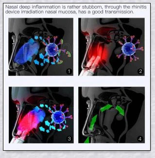 Infrared Rhinitis Therapy Device - A revolutionary medical-grade solution for allergy relief and nasal comfort