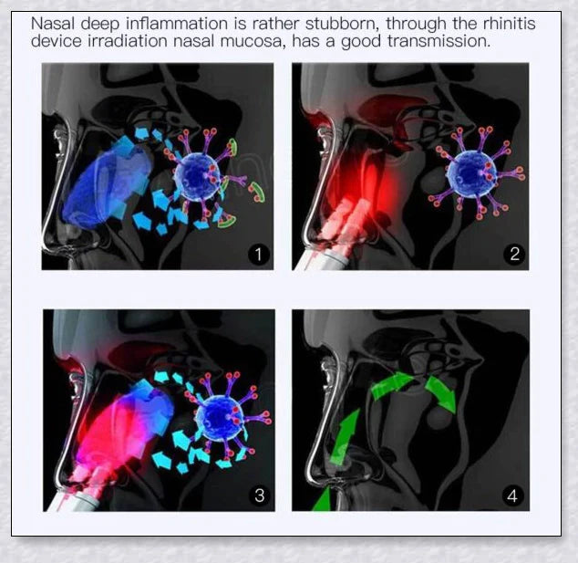 Infrared Rhinitis Therapy Device - A revolutionary medical-grade solution for allergy relief and nasal comfort
