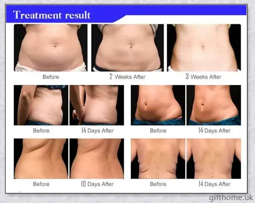Body Slimming and Anti-Cellulite Massager with Ultrasonic Cavitation Fat Burning Technology