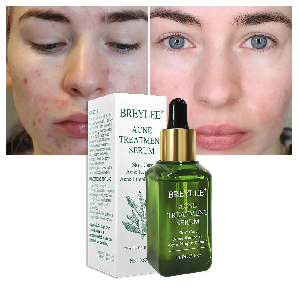 BREYLEE Acne Treatment Serum bottle with natural ingredients for acne and scar removal