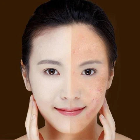 Blue light therapy pen for treating acne, scars, and wrinkles on the face and body