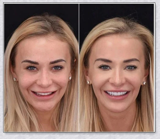 Magic Teeth Brace Veneer - Custom-fitted dental veneers to instantly transform your smile