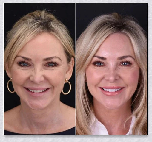Magic Teeth Brace Veneer - Custom-fitted dental veneers to instantly transform your smile
