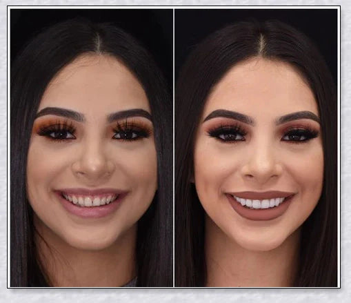 Magic Teeth Brace Veneer - Custom-fitted dental veneers to instantly transform your smile