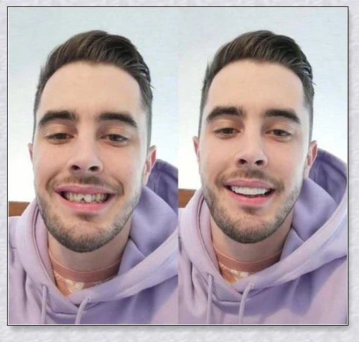 Magic Teeth Brace Veneer - Custom-fitted dental veneers to instantly transform your smile