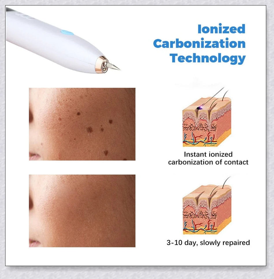 Skin Tag Wart Mole Remover Plasma Pen - Convenient at-home solution for removing skin imperfections