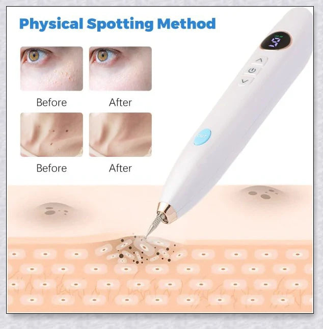 Skin Tag Wart Mole Remover Plasma Pen - Convenient at-home solution for removing skin imperfections