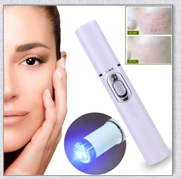 Spider Veins Removal Pen - a high-intensity light device to eliminate varicose veins, treat acne, and promote lymph detoxification