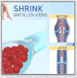 Spider Veins Removal Pen - a high-intensity light device to eliminate varicose veins, treat acne, and promote lymph detoxification