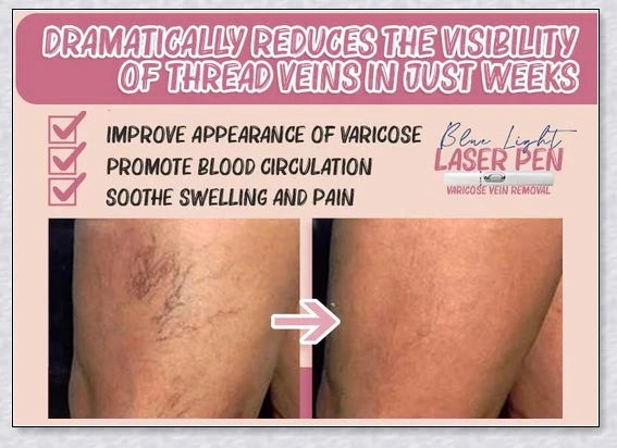 Spider Veins Removal Pen - a high-intensity light device to eliminate varicose veins, treat acne, and promote lymph detoxification
