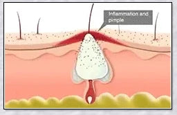 Spider Veins Removal Pen - a high-intensity light device to eliminate varicose veins, treat acne, and promote lymph detoxification