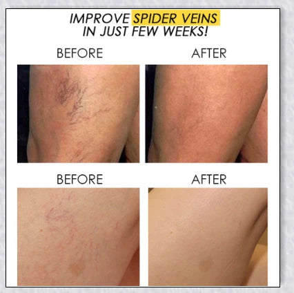 Spider Veins Removal Pen - a high-intensity light device to eliminate varicose veins, treat acne, and promote lymph detoxification