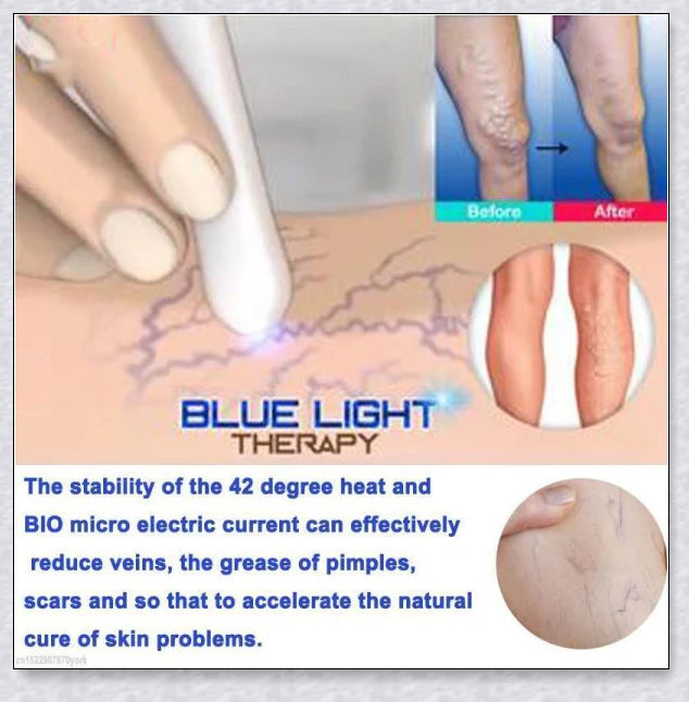 Spider Veins Removal Pen - a high-intensity light device to eliminate varicose veins, treat acne, and promote lymph detoxification