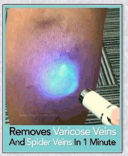 Spider Veins Removal Pen - a high-intensity light device to eliminate varicose veins, treat acne, and promote lymph detoxification
