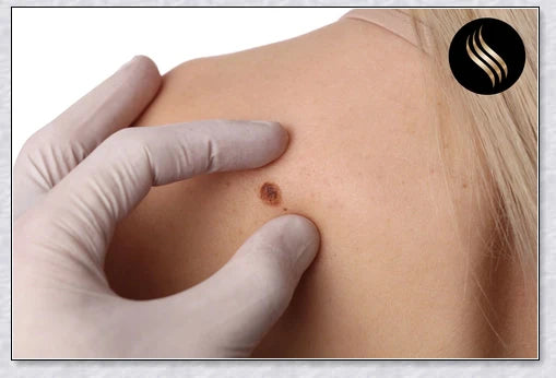 Skin Tag and Mole Remover - Innovative nano-needle technology for safe, effective blemish removal