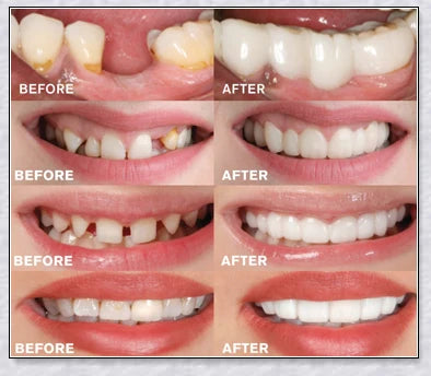 Premium snap-on veneers made with micro-thin polypropylene to instantly transform your smile