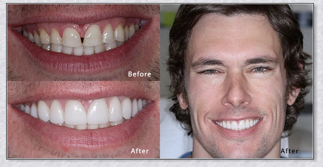 Premium snap-on veneers made with micro-thin polypropylene to instantly transform your smile
