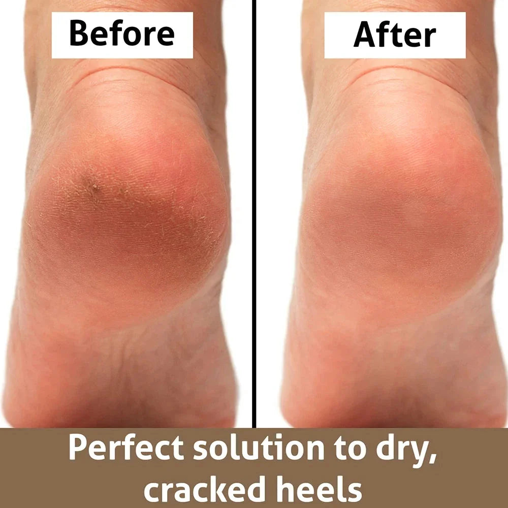 Professional Foot File Rasp for Callus Removal - Durable Stainless Steel Construction with Elegant Golden Finish