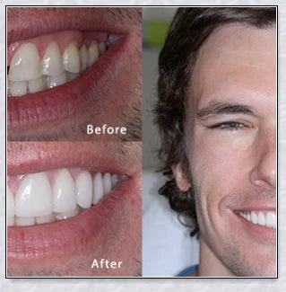 Premium snap-on veneers made with micro-thin polypropylene to instantly transform your smile