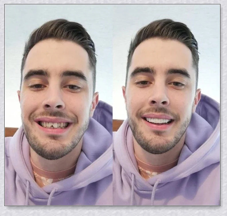 Premium snap-on veneers made with micro-thin polypropylene to instantly transform your smile