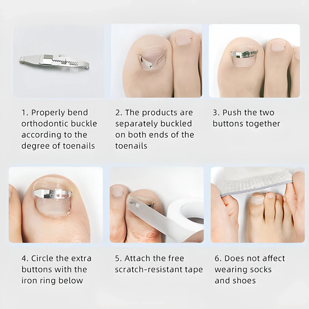 Premium professional ingrown toenail corrector tool with adjustable orthopedic nail buckle, made from durable stainless steel