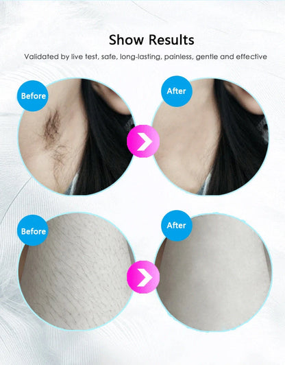Premium laser hair removal device with adjustable intensity levels for smooth, hair-free skin