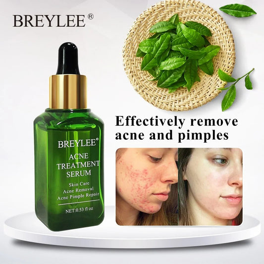 BREYLEE Acne Treatment Serum bottle with natural ingredients for acne and scar removal