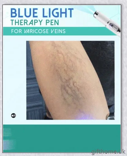 BlueLight Therapy Pen for Varicose Veins - Safe, Effective, and Convenient Home Remedy for Eliminating Unsightly Veins