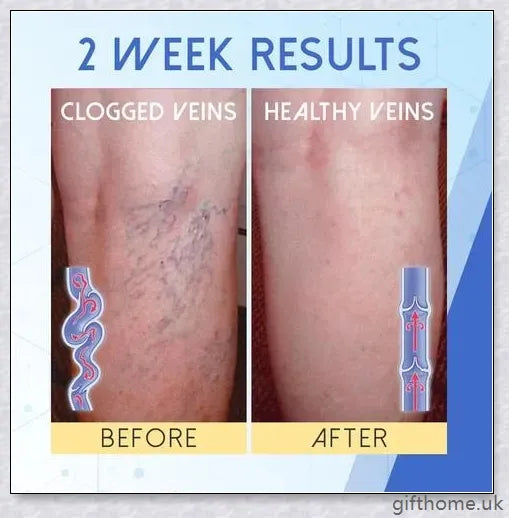 BlueLight Therapy Pen for Varicose Veins - Safe, Effective, and Convenient Home Remedy for Eliminating Unsightly Veins