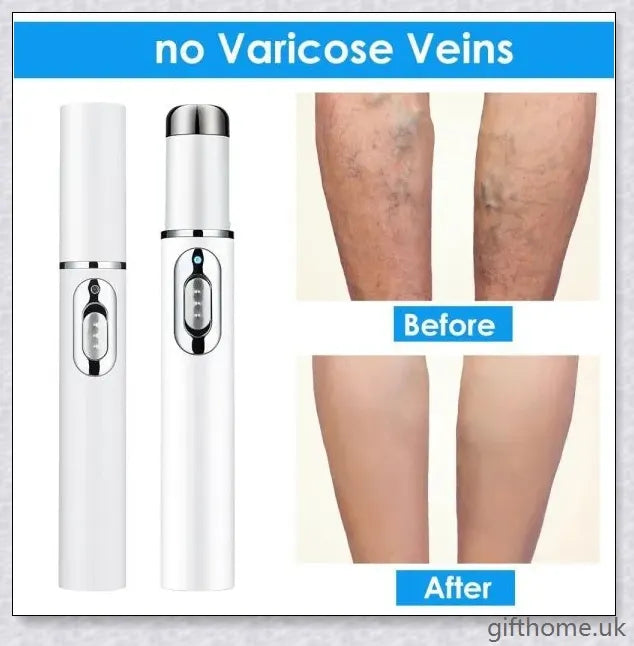 BlueLight Therapy Pen for Varicose Veins - Safe, Effective, and Convenient Home Remedy for Eliminating Unsightly Veins
