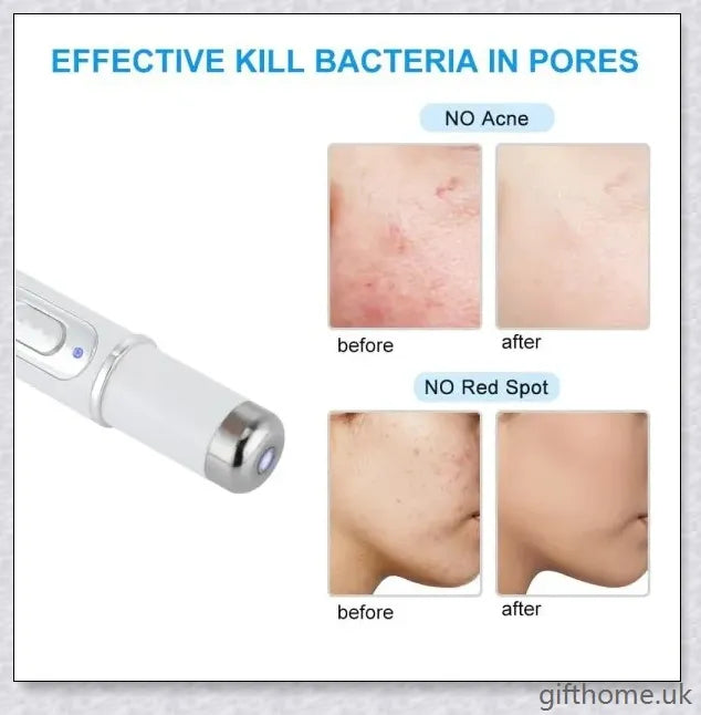 BlueLight Therapy Pen for Varicose Veins - Safe, Effective, and Convenient Home Remedy for Eliminating Unsightly Veins