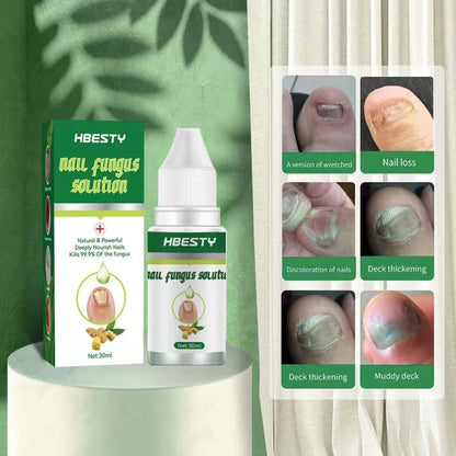 Nail Fungus Treatment Solution with Natural Ingredients Like Honeysuckle and Hyaluronic Acid