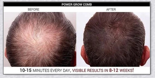 Professional Hair Regrowth Laser Comb with laser technology for stimulating hair growth and reducing hair loss