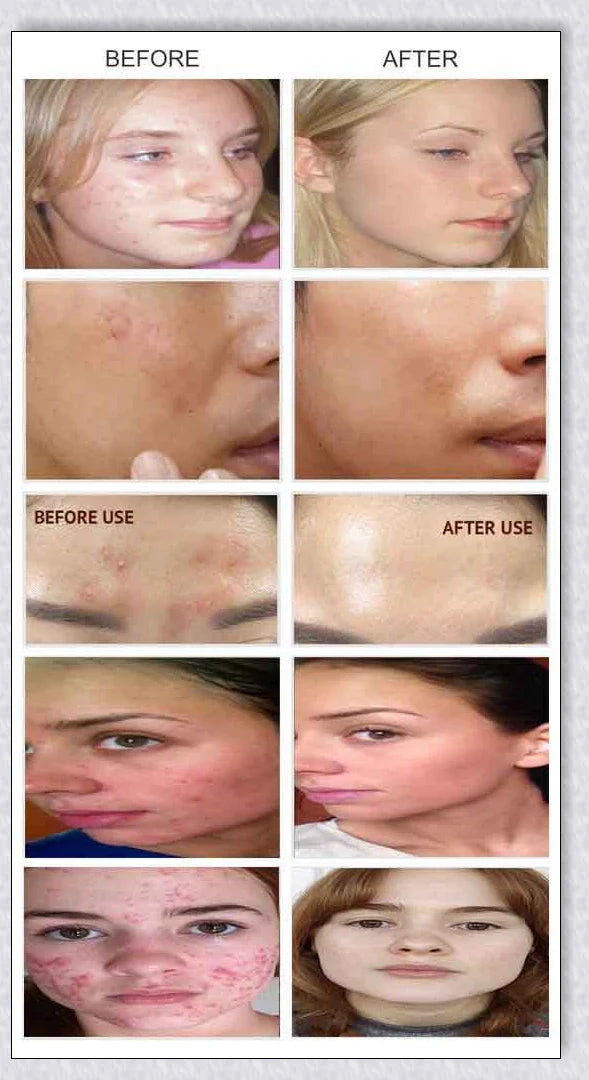 Mabox Award Winning Acne Clarifying Serum with 20% Vitamin C, designed to reduce blemishes and promote a radiant, healthy complexion.