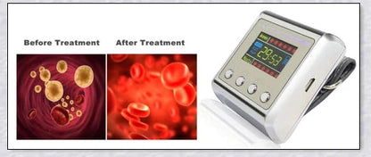 The Hypertension Laser Therapy Watch, a cutting-edge device that uses low-intensity laser therapy to improve blood circulation and manage hypertension.