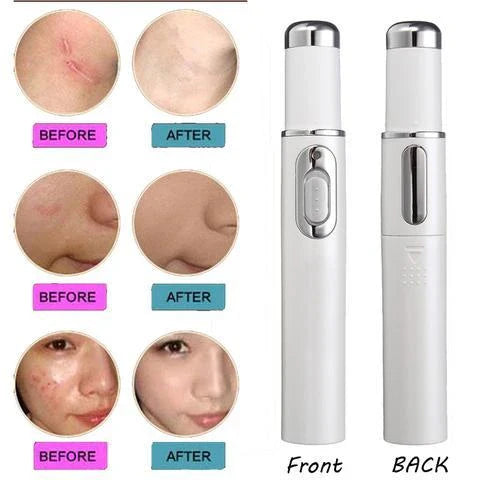 Blue light therapy pen for treating acne, scars, and wrinkles on the face and body