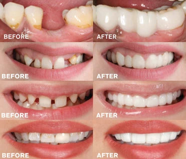Snap-on dentures providing a natural-looking, perfect smile solution