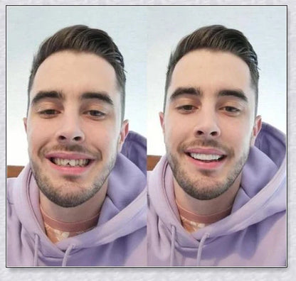 Magic Teeth Brace Veneer - Custom-fitted dental veneers to instantly transform your smile