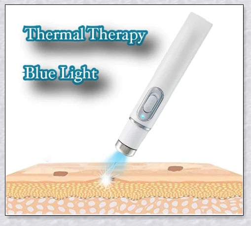 Blue Light Laser Pen for Effortless Spot Removal at Home
