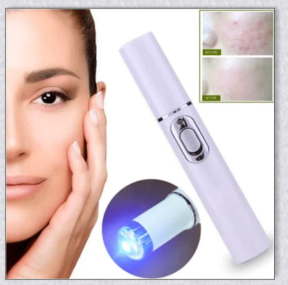 Spider Veins Removal Pen - a high-intensity light device to eliminate varicose veins, treat acne, and promote lymph detoxification