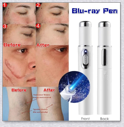 Spider Veins Removal Pen - a high-intensity light device to eliminate varicose veins, treat acne, and promote lymph detoxification