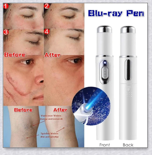 Spider Veins Removal Pen - a high-intensity light device to eliminate varicose veins, treat acne, and promote lymph detoxification