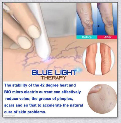 Spider Veins Removal Pen - a high-intensity light device to eliminate varicose veins, treat acne, and promote lymph detoxification
