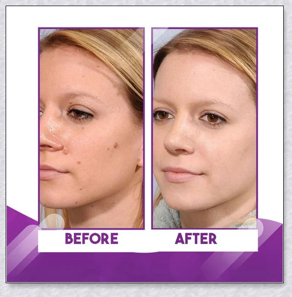 Premium organic skin tag removal serum with natural botanical ingredients for effective, gentle skin rejuvenation