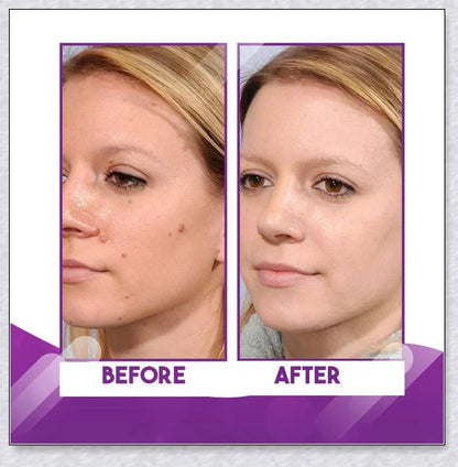 Premium organic skin tag removal serum with natural botanical ingredients for effective, gentle skin rejuvenation