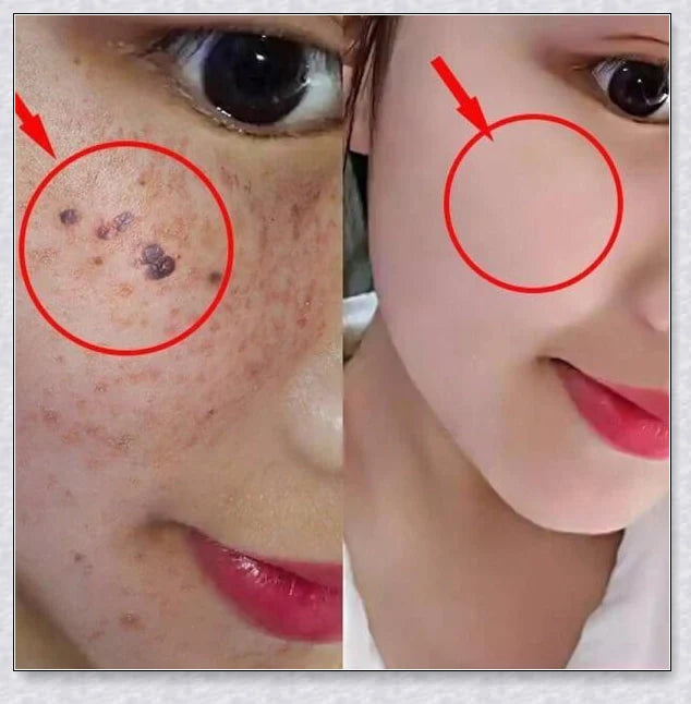 Premium organic skin tag removal serum with natural botanical ingredients for effective, gentle skin rejuvenation